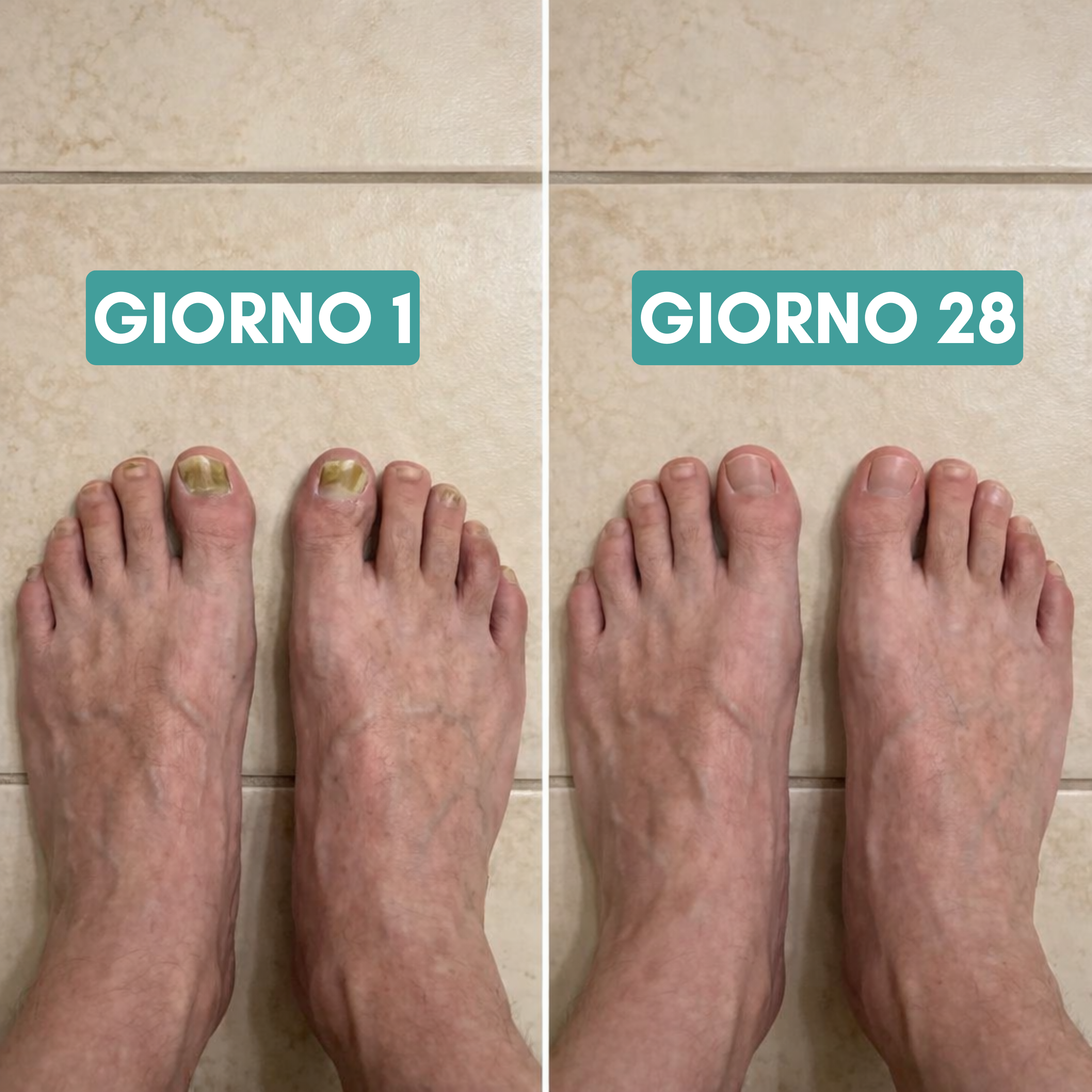 Apparecchio Anti micosi DermaGlide